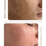 Acompanhamento Luméa Para Melasma