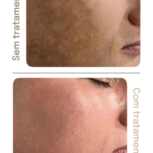 Acompanhamento Luméa Para Melasma