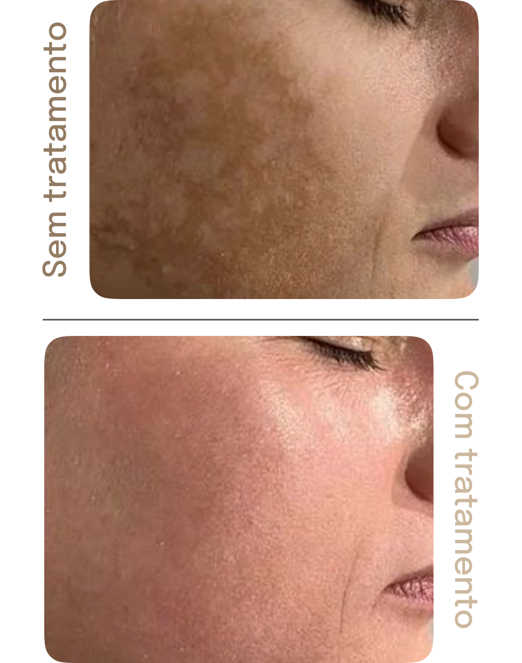 Acompanhamento Luméa Para Melasma